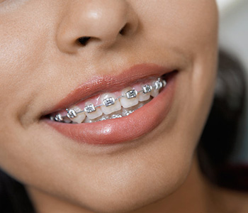 Dr Munira Lokhandwala, Starbrite Dental, Invisalign Before and After Service