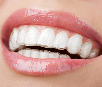 Dr Munira Lokhandwala, Starbrite Dental, Providing invisible braces