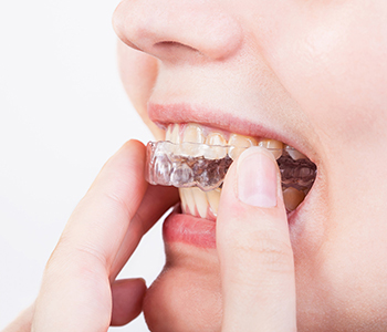 Dr Munira Lokhandwala, Starbrite Dental, Providing invisalign braces