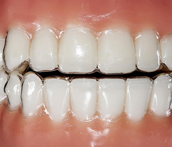Dr Munira Lokhandwala, Starbrite Dental, Providing invisalign prices