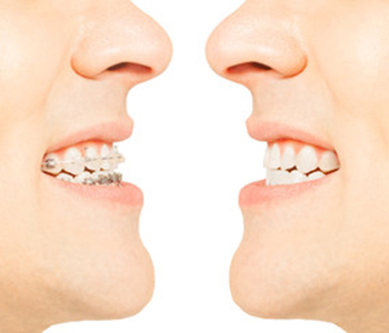 Dr Munira Lokhandwala, Starbrite Dental, Providing invisalign in fremont