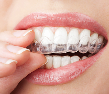 Dr Munira Lokhandwala, Starbrite Dental, Providing Teeth whith white tray
