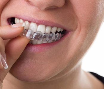 Dr Munira Lokhandwala, Starbrite Dental, Providing Invisalign treatment