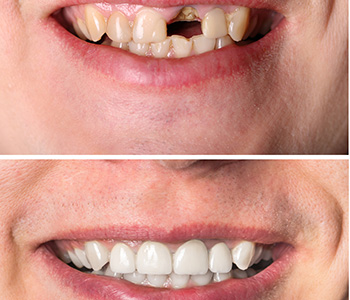 Dr Munira Lokhandwala, Starbrite Dental, Providing lumineers san jose
