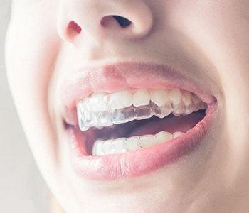 Dr Munira Lokhandwala, Starbrite Dental, Providing Invisalign in san jose