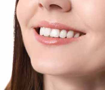 Image of a woman used invisalign after 