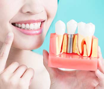 Lady displaying a dental implant structure