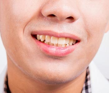 Yellow teeth in Fremont CA area