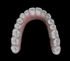 How invisalign work