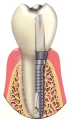 Dental implant illustration