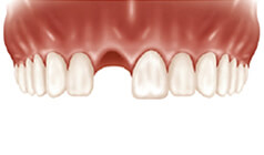  Single tooth missing 