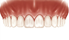  Replacement of a single tooth final result