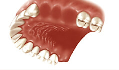  Three missing teeth 