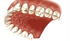  Final result  after replacement of crowns and implants