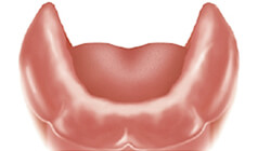  Before implant-supported denture 