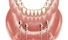  Denture is attached to implants  