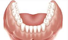 Final result - Denture snapped in