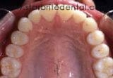 After invisalign treatment