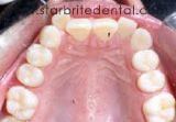 Before invisalign treatment