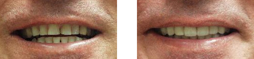 Porcelain Veneers Before/After 01