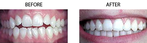  Six Month Braces Before/After 01