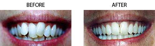 Six Month Braces Before/After 02