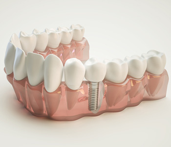 Dental implant illustration