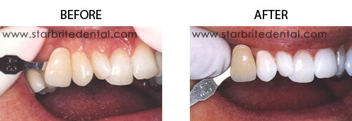 In-Office Zoom Teeth Whitening before after 02