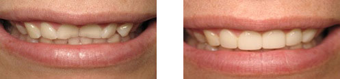 Porcelain Veneers Before/After 10