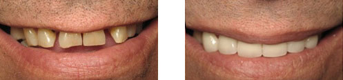 Porcelain Veneers Before/After 11