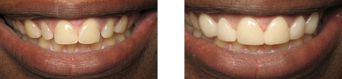 Porcelain Veneers Before/After 12