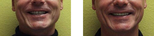 Porcelain Veneers Before/After 02