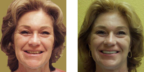 Porcelain Veneers Before/After 04