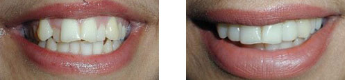 Porcelain Veneers Before/After 05