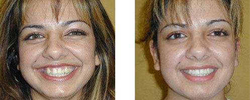 Porcelain Veneers Before/After 06