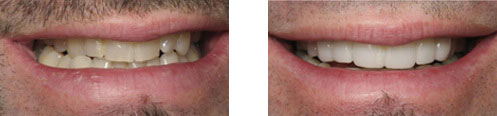 Porcelain Veneers Before/After 07