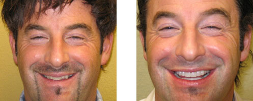 Porcelain Veneers Before/After 08