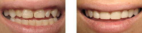 Porcelain Veneers Before/After 09