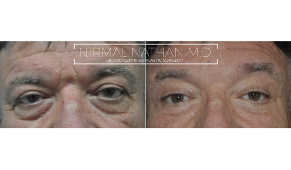 Face before after 3