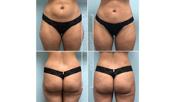 Body before after 1