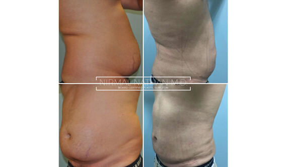 Body before after 2