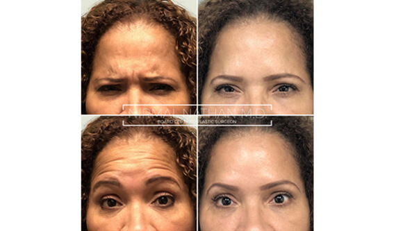 Nonsurgical before after 1