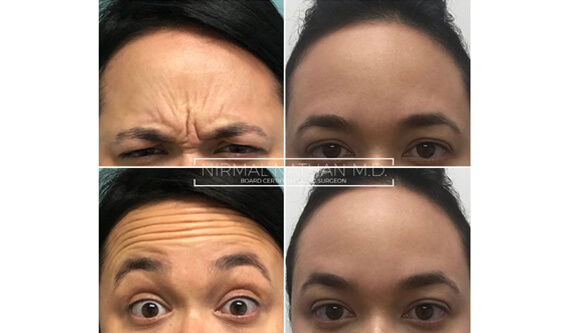 Nonsurgical before after 2