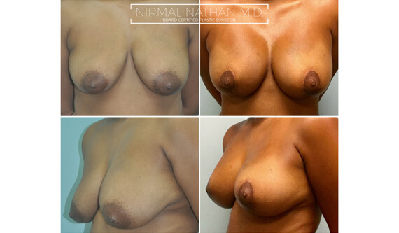 Breast before after 2