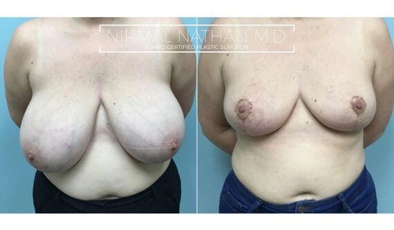 Breast before after 4