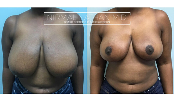 Breast before after 5