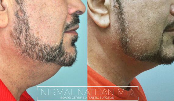 Face before after 1