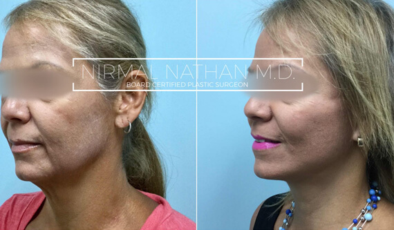 Face before after 2