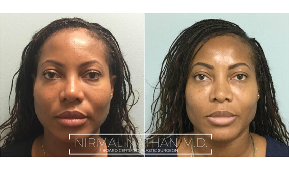 Nonsurgical before after 3