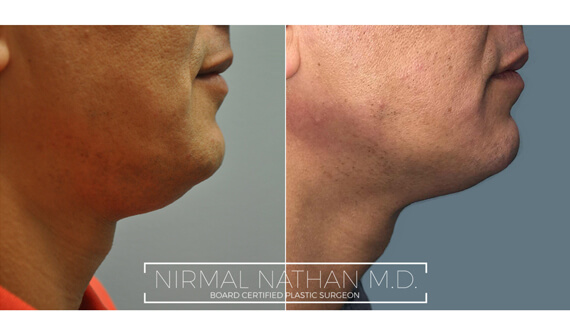 Nonsurgical before after 5